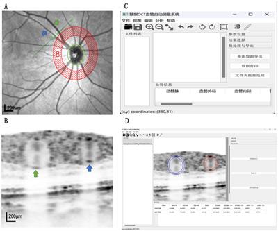 A semantic segmentation method to analyze retinal vascular parameters of diabetic nephropathy